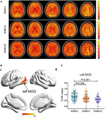 Abnormal Cerebrovascular Reactivity and Functional Connectivity Caused by White Matter Hyperintensity Contribute to Cognitive Decline